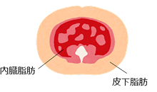 画像:皮下脂肪型肥満