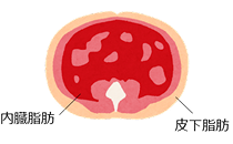 画像:内臓脂肪型肥満