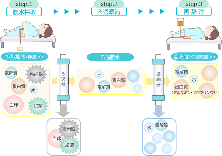 画像:CARTの治療イメージ図、step.1、腹水採取、採取腹水、電解質、蛋白質、血球、癌細胞、水、細菌をろ過器に通す、癌細胞、血球、細菌を取り除きろ過腹水を作る、step.2ろ過濃縮:ろ過腹水、水、電解質、蛋白質を濃縮器に通す、step.3再静注:濃縮腹水、電解質、水、蛋白質(アルブミン、グロブリンなど)を腹腔内に戻す