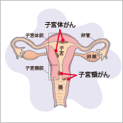若い女性にも増加傾向 女性特有のがんを知ろう