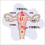 若い女性にも増加傾向　女性特有のがんを知ろう