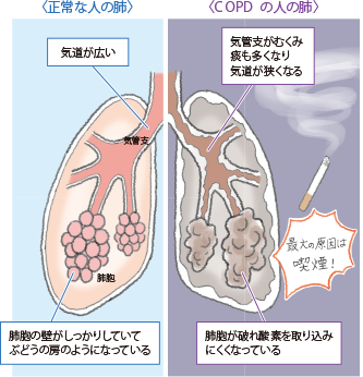 画像:正常な人の肺 COPDの人の肺