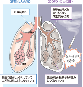 喫煙年数の長い人は要注意 呼吸困難に陥るcopdとは 公立学校共済組合