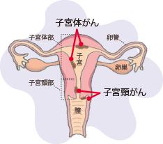 画像:子宮体がん、子宮頸がん