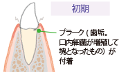 画像:歯周病の進行 初期