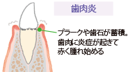 画像:歯周病の進行 歯肉炎