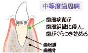 画像:歯周病の進行 中等度歯周病