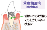 画像:歯周病の進行 重度歯周病