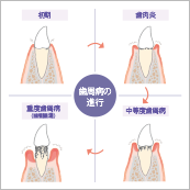 歯周病は全身に関わる病気 お口の問題だけではない!