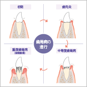 歯周病は全身に関わる病気 お口の問題だけではない！